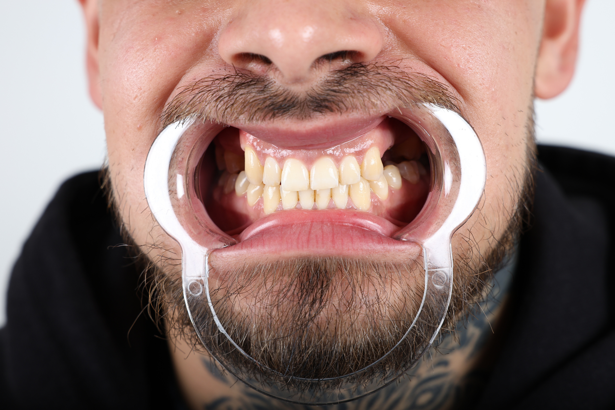 Before Zirconia Crown Treatment